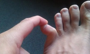 足の小指　骨折